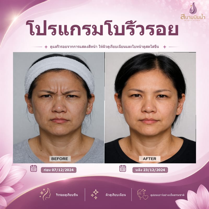ภาพก่อน–หลัง โบท็อกซ์ริ้วรอย กรณีเฉพาะบุคคล