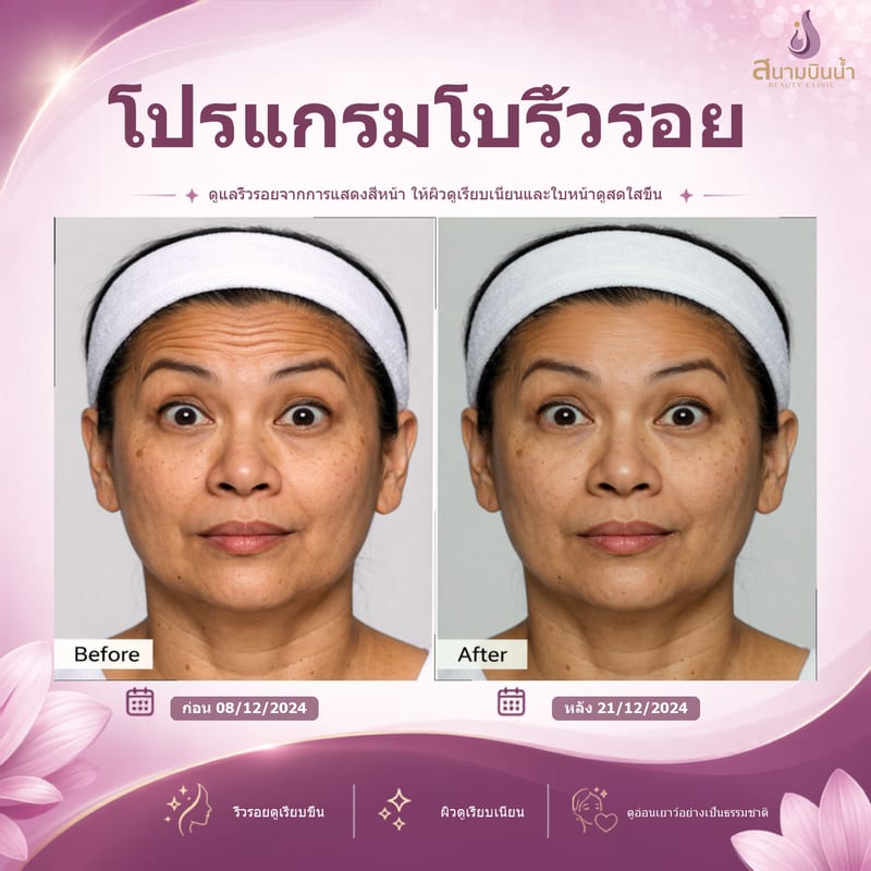 ภาพก่อน–หลัง โบท็อกซ์ริ้วรอย กรณีเฉพาะบุคคล