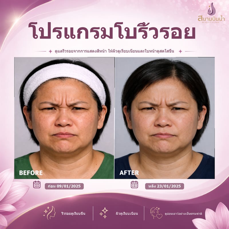 ภาพก่อน–หลัง โบท็อกซ์ริ้วรอย กรณีเฉพาะบุคคล