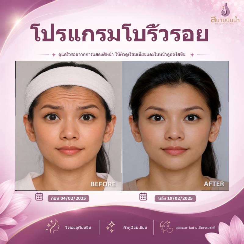 ภาพก่อน–หลัง โบท็อกซ์ริ้วรอย กรณีเฉพาะบุคคล