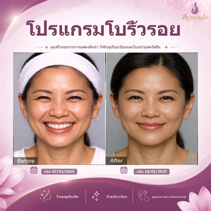 ภาพก่อน–หลัง โบท็อกซ์ริ้วรอย กรณีเฉพาะบุคคล