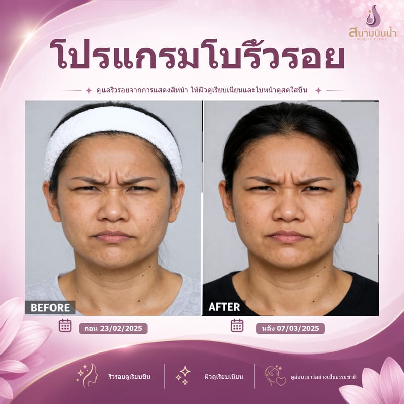 ภาพก่อน–หลัง โบท็อกซ์ริ้วรอย กรณีเฉพาะบุคคล
