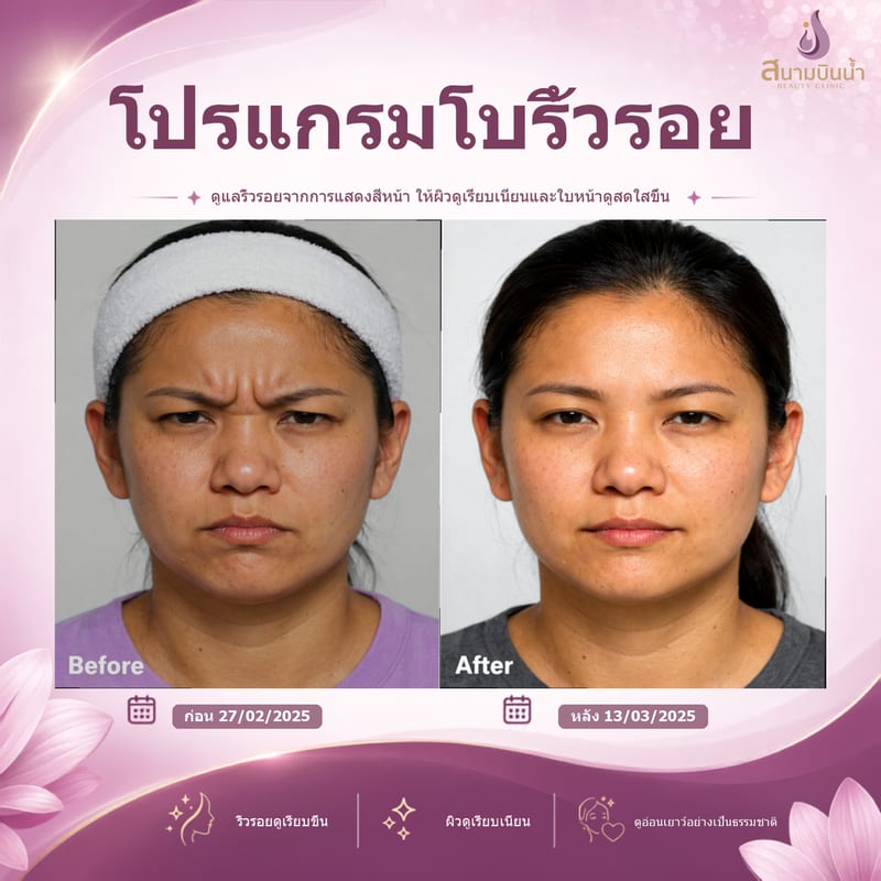 ภาพก่อน–หลัง โบท็อกซ์ริ้วรอย กรณีเฉพาะบุคคล