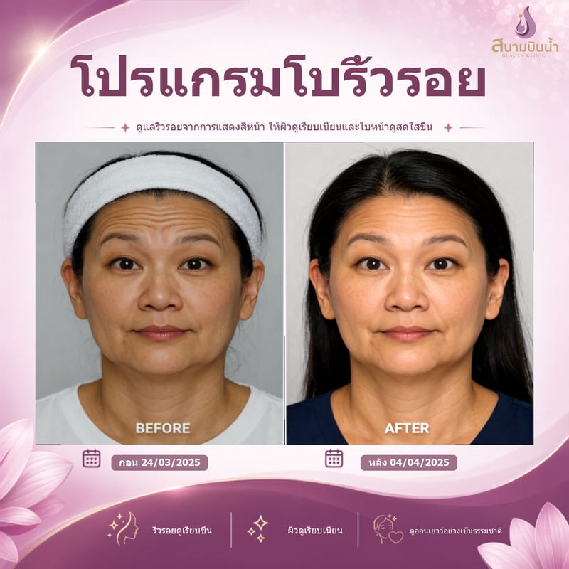 ภาพก่อน–หลัง โบท็อกซ์ริ้วรอย กรณีเฉพาะบุคคล