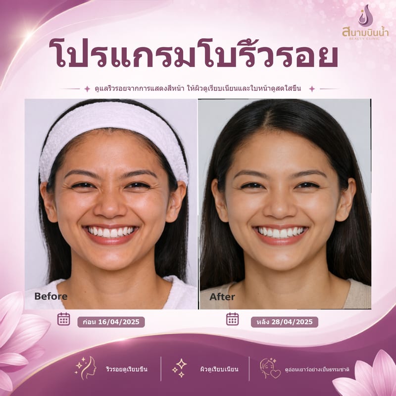 ภาพก่อน–หลัง โบท็อกซ์ริ้วรอย กรณีเฉพาะบุคคล