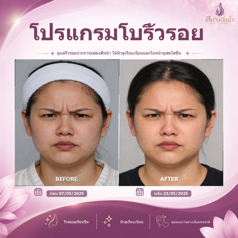 ภาพก่อน–หลัง โบท็อกซ์ริ้วรอย กรณีเฉพาะบุคคล