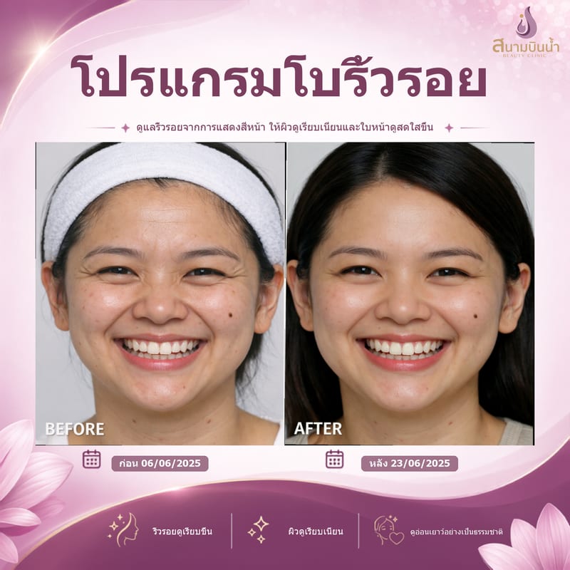 ภาพก่อน–หลัง โบท็อกซ์ริ้วรอย กรณีเฉพาะบุคคล