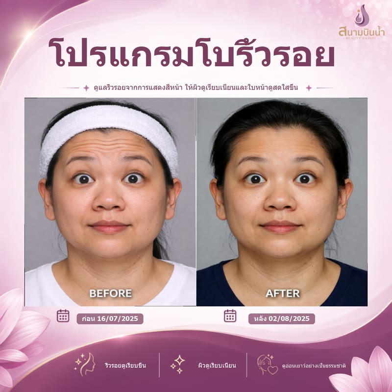 ภาพก่อน–หลัง โบท็อกซ์ริ้วรอย กรณีเฉพาะบุคคล